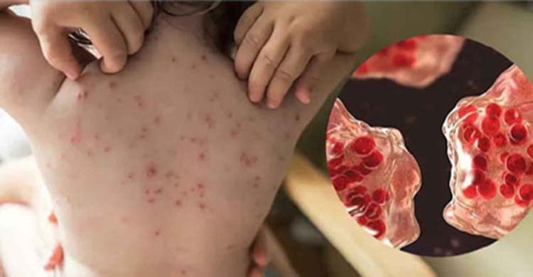 হাম ও উপসর্গ নিয়ে একদিনে আরও ১০ শিশুর মৃত্যু