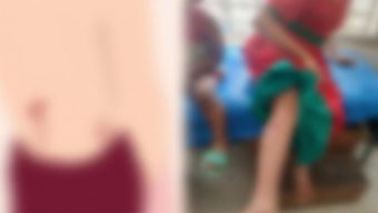 হবিগঞ্জে পাগলা কুকুরের কামড়ে স্কুল ছাত্রীসহ আ হ ত অর্ধশত